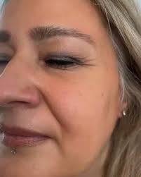 MAGIC GLOW LIFT A very natural tightening rejuvenation of skin (without  volume ) using a very unique cocktail of Vitamins and botulinum toxin  .(Botox diluted with vitamins ) .Not only does it it ...