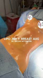 Liposuction 360 + Breast Aug