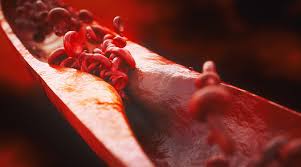 Cholesterin Zu Hoch Was Tun Wenn Das Blut Ins Stocken Gerat