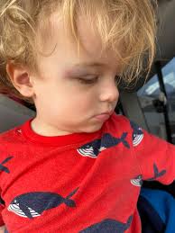 oh no! Disco hurt his head when he fell in the bath. The little bruise  above his eye is where he hit.