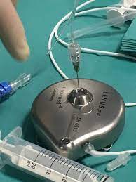 Angesichts der bisherigen anwendung der lenus pro® pumpe im rahmen der individualisierung heilungsversuche halten die initiatoren der geplanten studie für notwendig stellen sie die sicherheit. Implantable Lenus Pro Pump For Treprostinil Infusion In Three Pediatric Patients Alvarez Fuente 2020 Pediatric Pulmonology Wiley Online Library