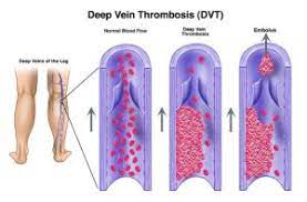 These clots tend to block blood vessels and cause corresponding symptoms. Blood Clots Massage During Pregnancy Postpartum Touch For Birth