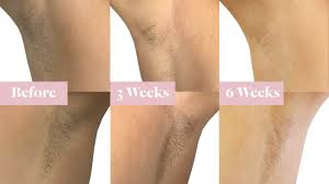 Area for which laser hair removal is being considered. Armpit Underarm Laser Hair Removal Laseraway