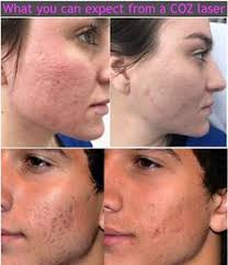 Check spelling or type a new query. 37 Fractional Co2 Laser Ideas