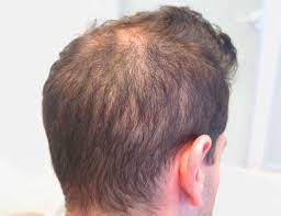 Keeps provides access to hair loss treatments through their website. Classification Of Hair Loss In Men Bernstein Medical