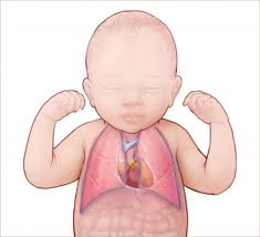 List of 54 cpam definitions. Ccam Cpam Congenital Cystic Adenomatoid Malformation Pulmonary Airway Malformation Children S Hospital Of Philadelphia