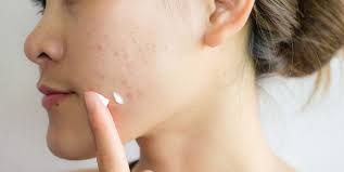 Treatment with a pulsed dye laser (pdl) can help reduce the itch and. 12 Best Moisturizers For Oily Acne Prone Skin In 2021