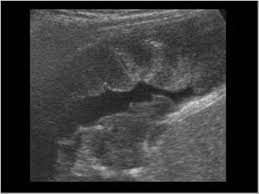 Symptoms of pleural thickening may include chest pain and difficulty . Thorax 8 2 Pleural Space Case 8 2 2 Benign And Malignant Pleural Thickening Ultrasound Cases