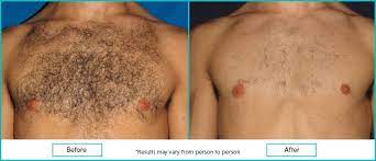 How to remove chest hair. How To Remove Chest Hair Temporary Vs Permanent Methods