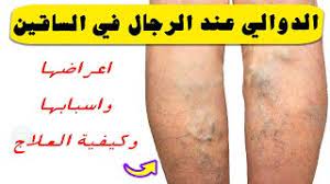 إذ تفقد الأوردة الدموية مرونتها بتقدم الإنسان في العمر، ممّا يتسبب بتمددها واتساعها، وهذا قد يؤدي إلى ضعف صمامات الأوردة، ممّا يجعل الدم يتجمع في الوريد. Ø§Ù„Ø¯ÙˆØ§Ù„ÙŠ Ø¹Ù†Ø¯ Ø§Ù„Ø±Ø¬Ø§Ù„ ÙÙŠ Ø§Ù„Ø³Ø§Ù‚ÙŠÙ† Ø£Ø¹Ø±Ø§Ø¶Ù‡Ø§ ÙˆØ£Ø³Ø¨Ø§Ø¨Ù‡Ø§ ÙˆÙƒÙŠÙÙŠØ© Ø§Ù„Ø¹Ù„Ø§Ø¬ Youtube