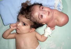From the attached sisters who fell in love with the same man to the twins that shared the same brain, here are the most severe cases of conjoined twins. 24 Why Would God Create Conjoined Twins Warning Contains Graphic Content 500 Questions About God Christianity
