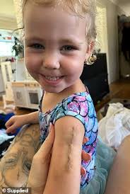 My three-year-old's itchy 'mozzie bite' was melanoma and it WASN'T caused  by the sun. Doctors said it was impossible but then things took a  terrifying turn