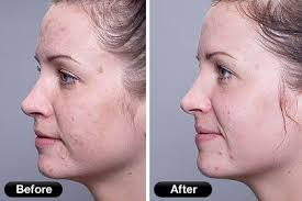 Pin On Red Light Therapy Before And After