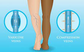 How Wearing Compression Stockings Can Help Your Varicose Veins Vein Health Clinic Melbourne