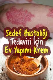 Sedef Hastaligi Tedavisi Icin Krem Yapimi Evde Nasil Yapilir Saglikli Dogal Saglik Saglikli Olmak