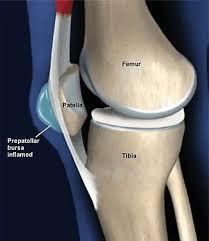 Image result for Prepatellar Bursa Injection