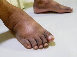Image result for diabetic toes
