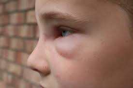 Geschwollene Augen Beim Kind Ursachen Und Behandlungsmoglichkeiten