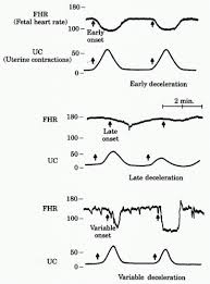 Image result for Early Deceleration