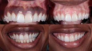 Gum Depigmentation And Bleaching Los Angeles La Periodontists
