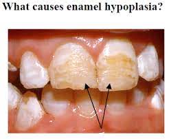 Enamel hypoplasia is common in children with low birthweight or systemic illness in the neonatal •enamel hypoplasia (or 4.2) •presence of s. Dental Haven Dr Gonzalo And Dr Alexandra Hernandez Kres8 Enamel Hypoplasia Appleton Wi Enamel Hypoplasia Causes Treatment Options