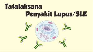 Penyakit lupus adalah penyakit autoimun yang dapat memengaruhi banyak organ dan jaringan. Tatalaksana Penyakit Lupus Atau Sle Kedokteran Caiherang