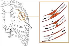 Image result for Chest Tube