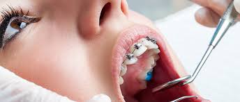 For many people, these spots appear in childhood and don't disappear as the person gets older no matter how much they brush their teeth. White Spots On Teeth During Orthodontic Treatment