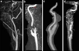 An artery tear, also called a dissection, occurs when layers of the interior arterial walls separate. Carotid Artery Dissection Radiology Key