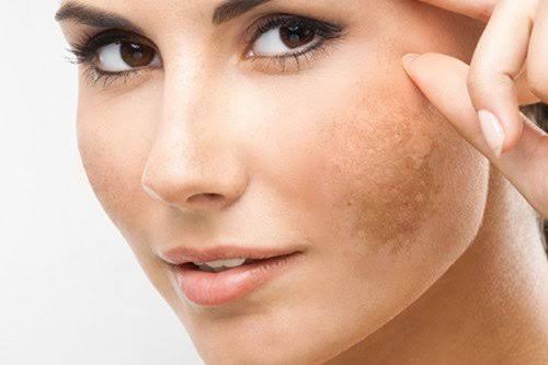 vì sao mấy yếu tố tưởng chừng không thể mà lại gây nên nám đậm hơn trên mặt?