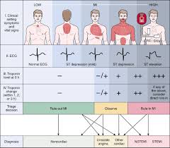 Image result for INTERCHEST Chest Pain Rule