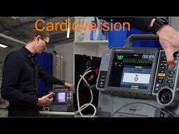 Image result for Synchronized Cardioversion