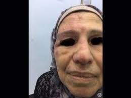 A Clınıcal Study of Herpes Zoster in Nineveh governorate patıents in Iraq