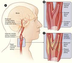 Closely related with the internal jugular vein and vagus nerve. Vascular Endovascular Surgery Carotid Artery Disease