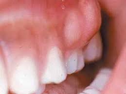 Obat Gusi Bengkak Tradisional Karena Gigi Berlubang Dapurobat Com Abscess Tooth Tooth Abcess Remedy Absessed Tooth
