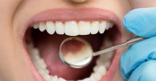 These acids can dissolve tooth enamel and dentin, which is directly below the enamel, by leaching calcium and phosphate minerals from these hard tooth tissues. How To Get Rid Of Cavities Home Remedies Prevention