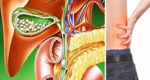 Dischinezia biliară este o boală comună a vezicii biliare. Semne Care IÈ›i AratÄƒ CÄƒ Ai Probleme Cu Fierea Cum SÄƒ Previi O CrizÄƒ BiliarÄƒ Secretele Com