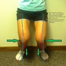 Shin Splints 101 Exercise Fitness Shin Splints