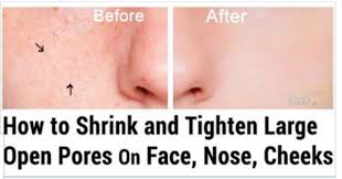 Here is what we know about how to shrink. How To Shrink And Tighten Large Open Pores On Face Nose And Cheeks Open Pores On Face Nose Pores Large Pores On Nose