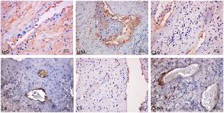 Frontiers Pathogenic Role Of Complement In Antiphospholipid Syndrome And Therapeutic Implications Immunology