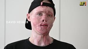 David Heimer var med om en fallskärmsolycka utanför Barcelona