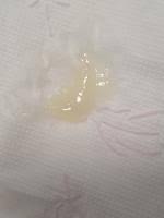 Mit dem ablösen des schleimpfropfes (ab der 38. Schleimpfropf Vorsicht Mit Bild Forum Schwangerschaft Urbia De