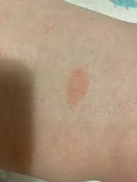 Image result for vyrážka u dětí