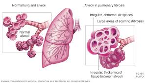 Parintii pot transmite modificarile genetice copiilor lor. Cum Se TransformÄ PlÄmanii Bolnavilor De FibrozÄ PulmonarÄ IdiopaticÄ Raportul De GardÄ