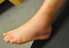There are several ligaments around your ankle. Sprained Ankle Orthoinfo Aaos