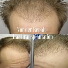 During the first two weeks, the transplanted hair will begin to shed. Hair Transplant Clinics Germany Hairforlife