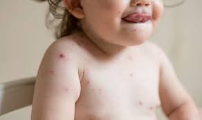 Image result for shingles in children