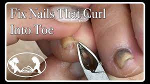 Fix Ingrown C Shape Toenail That Curls Into The Toe Trumpet Pincer Nail Tutorial Youtube Nail Problems Toe Nails Natural Nails Manicure