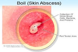 The skin around your boil will be slightly red and tender, and the skin around the boil will. How To Get Rid Of Boils Causes Symptoms Prevention Treatment Pictures