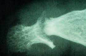 Usmlepathslides Psoriatic Arthritis X Ray With Pencil In Cup Deformity From Erosive Arthritis Of Digits Arthritis Psoriatic Arthritis Knee Arthritis